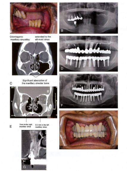 重度歯周病により吸収された歯槽骨の再生治療後のインプラント治療効果